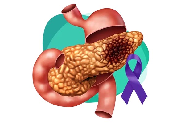 “El Día Mundial del Cáncer de Páncreas invita a reflexionar sobre su impacto global y la urgencia de mejorar su detección y tratamiento.” Foto creada con IA.